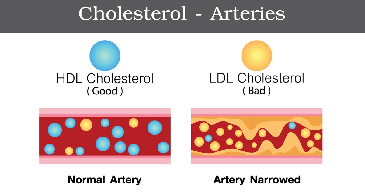 Dobar I Loš Holesterol