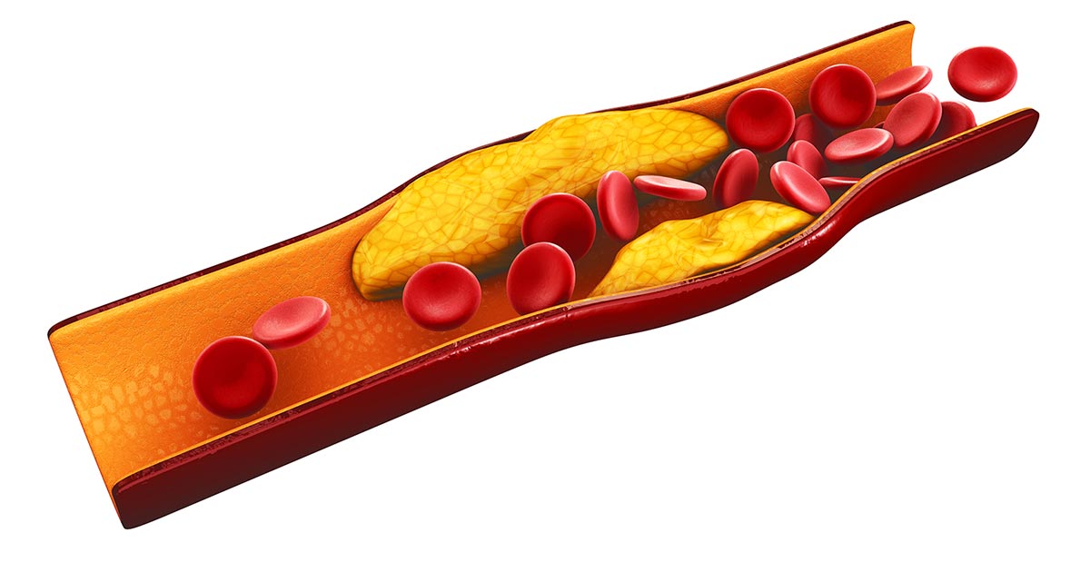 Zapušena Arterija Zbog Visokog Holesterola